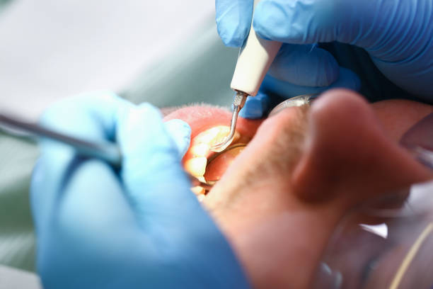 Best Urgent Care for Lost Fillings or Crowns in Coarsegold, CA